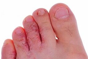 ayak parmaklarında mantar